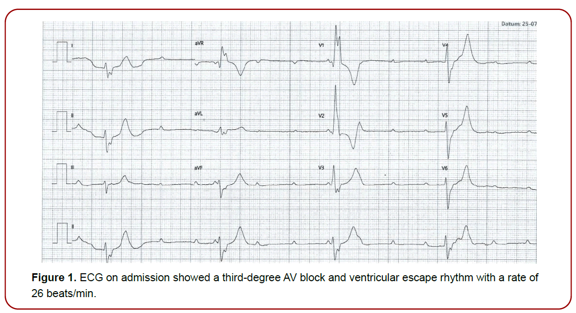 cardiovascular-diseases-therapeutics-ventricular-escape cardiovascular-diseases-therapeutics-ventricular-escape