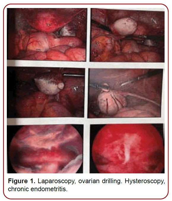 gynecology-maternal-health-ovarian-drilling gynecology-maternal-health-ovarian-drilling