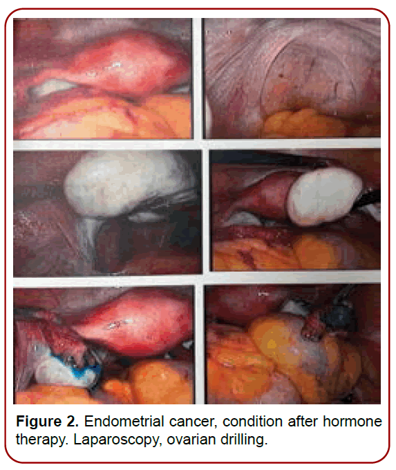 gynecology-maternal-health-ovarian-drilling gynecology-maternal-health-ovarian-drilling