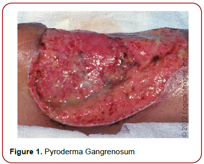healthcare-advanced-nursing-pyroderma-gangrenosum