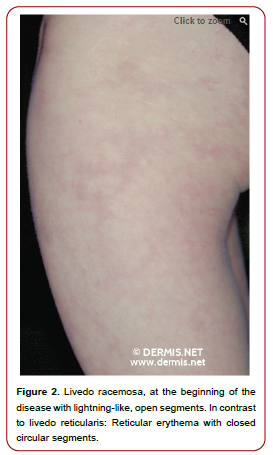 healthcare-advanced-nursing-pyroderma-gangrenosum