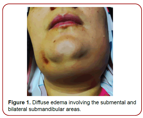 oral-diseases-treatment-edema-involving