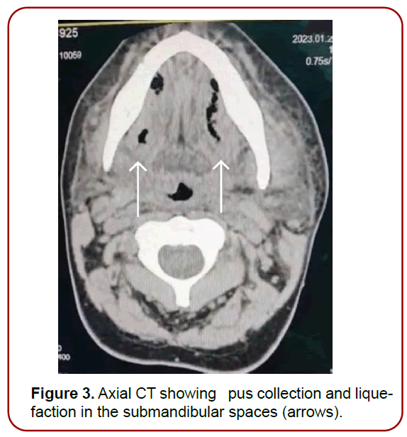 oral-diseases-treatment-edema-involving