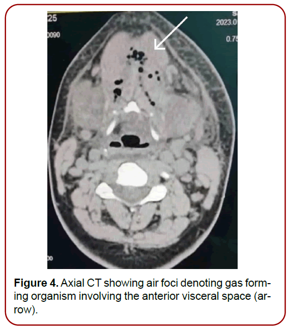 oral-diseases-treatment-edema-involving