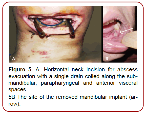 oral-diseases-treatment-edema-involving