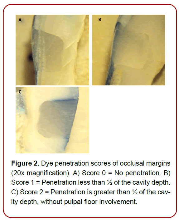 oral-diseases-treatment-pulpal-floor-involvement
