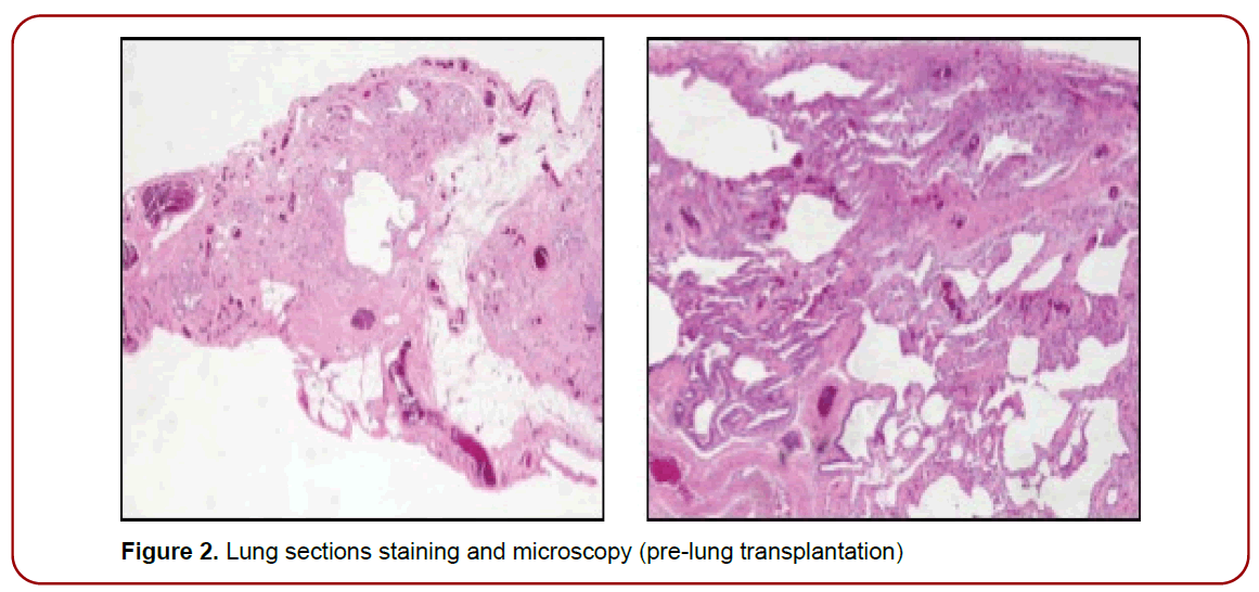 pulmonary-respiratory-diseases-pre-lung-transplantation